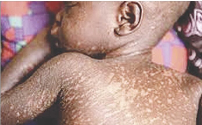 Measles Cases Statistics