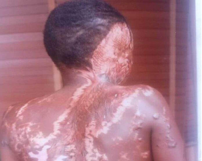 Adamawa Acid Attack